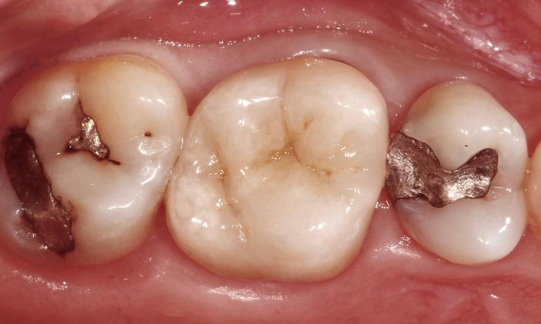 Crowns-After-Image