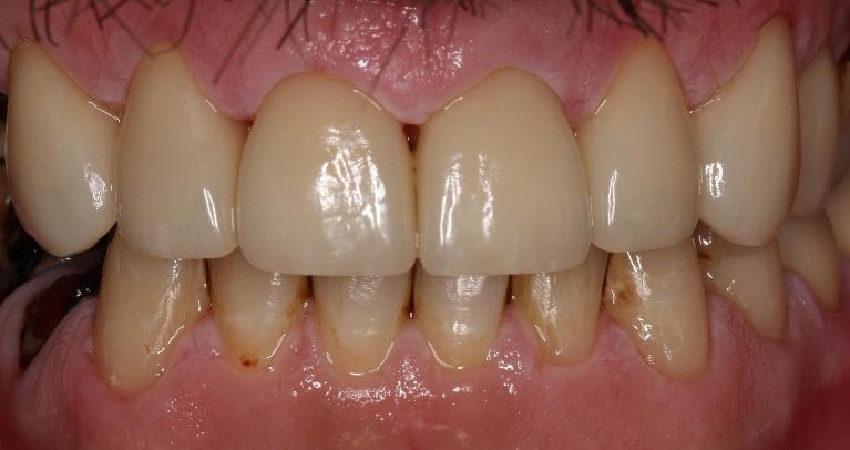 Crowns-After-Image
