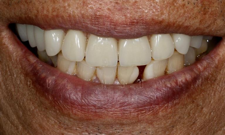 Aesthetic-Dentures-After-Image
