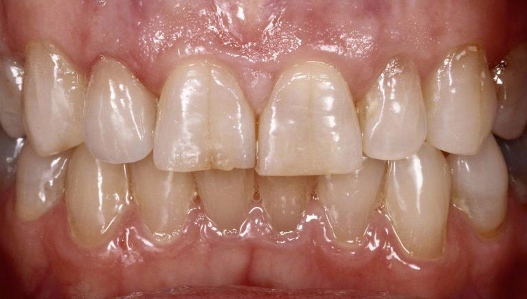Cosmetic-Dentistry-After-Image