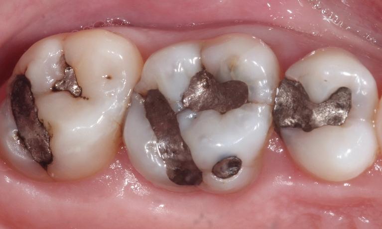 Crowns-Before-Image