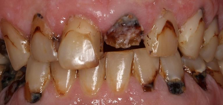 Crowns-Before-Image