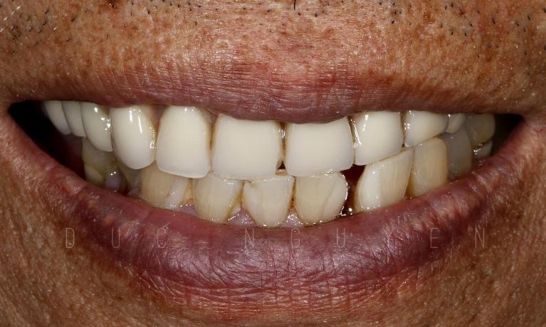 Aesthetic-Dentures-Before-Image